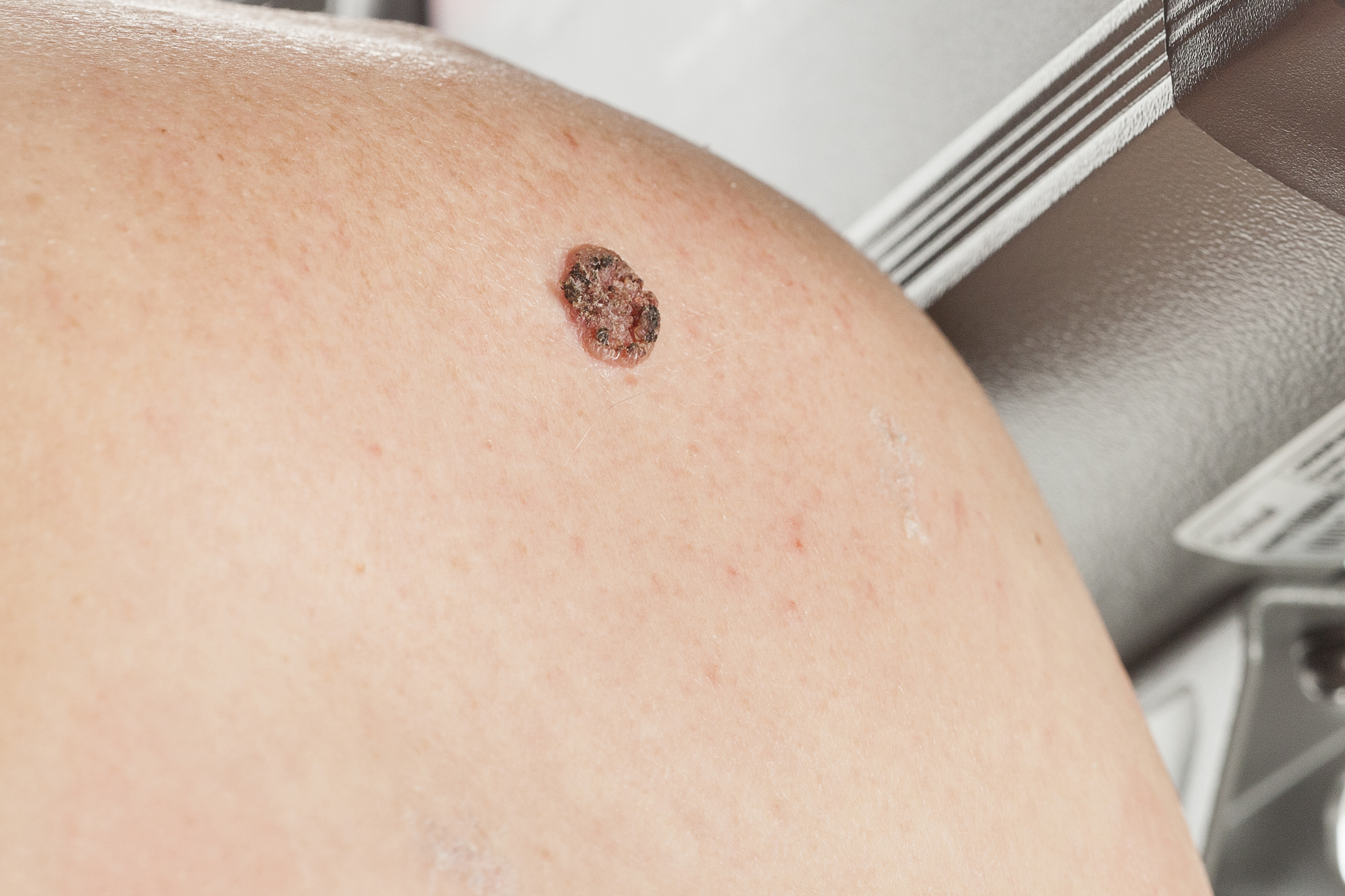squamous cell skin cancer